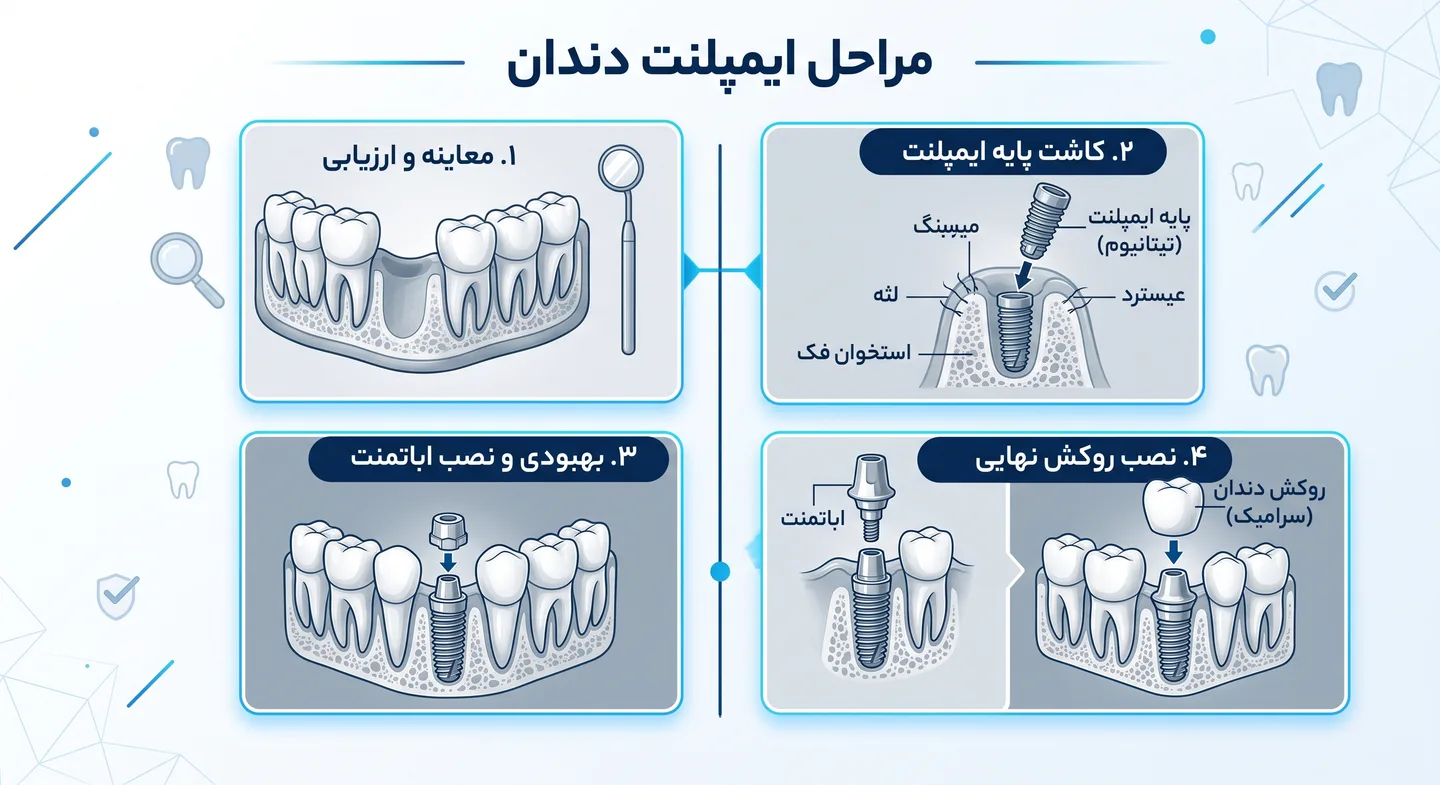کاشت دندان قسطی؛ راهنمای انتخاب مرکز مناسب و بررسی هزینه‌ها