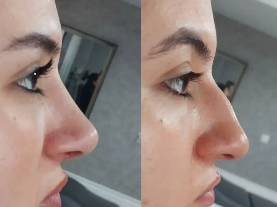 جراحی زیبایی بینی دکتر نجمه برخورداری 
